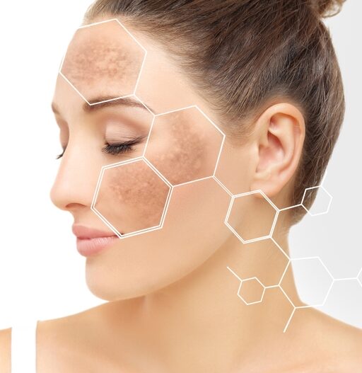 Hyperpigmentation 101: Causes, Prevention, and Top Treatment Options