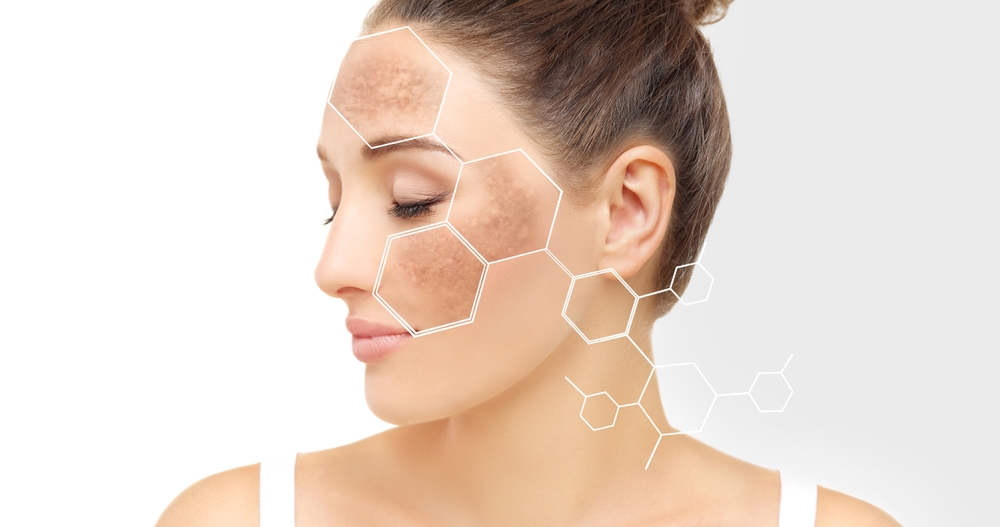 Hyperpigmentation 101: Causes, Prevention, and Top Treatment Options