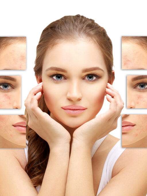How to Treat Acne Scars: Top 4 Med Spa Treatments for Smooth Skin
